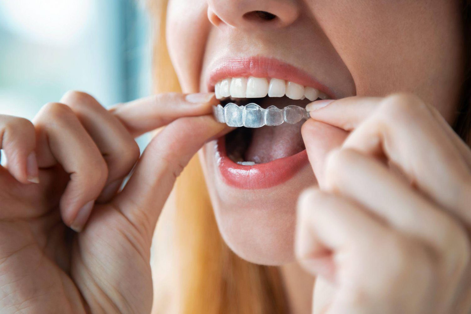 The Impact of Invisalign on Daily Life in London